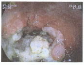 悪性腫瘍ができた腸管